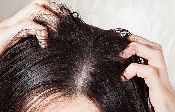 Hair smoothing methods cause dandruff